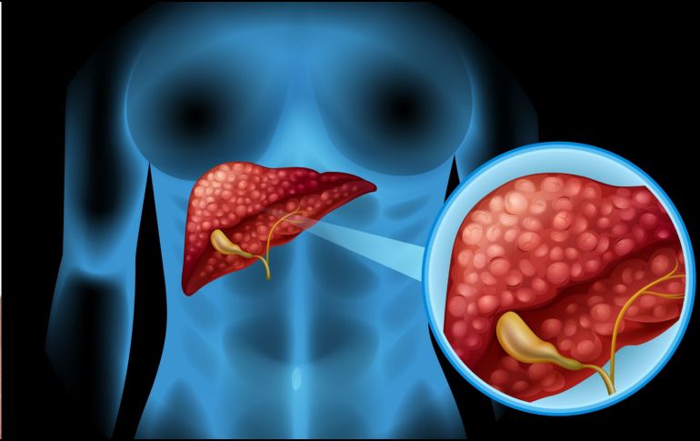 El hígado graso no alcohólico se asocia estrechamente con el síndrome metabólico, la obesidad, la diabetes tipo 2 y los niveles altos de colesterol o triglicéridos.  CANVA