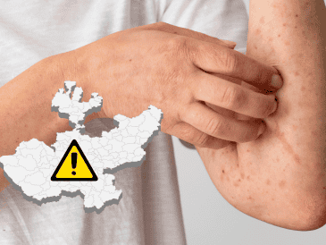 Hasta el corte más reciente de la dependencia estatal, sumaban 136 casos confirmados de sarampión en la Entidad.CANVA