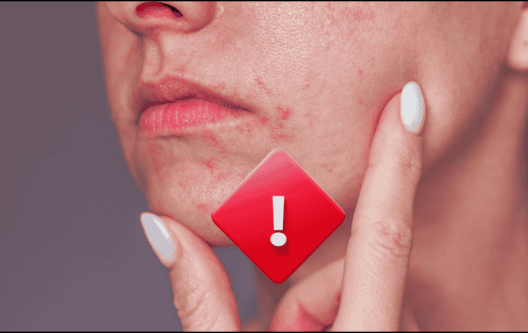 ¿Por qué sale la dermatitis perioral? No hay una causa clara, de hecho, es un conjunto de factores hormonales, predisposición genética e incluso factores ambientales. ESPECIAL / CANVA