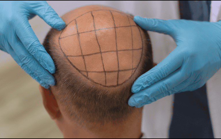 Otra de las razones que aúpan a esta clínica de injerto de cabello como la mejor del país, radica en la figura de su director. ESPECIAL