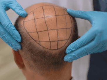 Otra de las razones que aúpan a esta clínica de injerto de cabello como la mejor del país, radica en la figura de su director. ESPECIAL