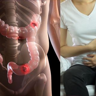 Cáncer de colon: el síntoma más "común" que debes atender enseguida