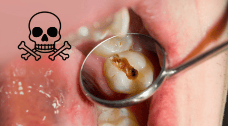 Existen factores que incrementan el riesgo de estas complicaciones, como la falta de atención odontológica, sistemas inmunológicos debilitados, enfermedades crónicas como la diabetes y el uso prolongado de ciertos medicamentos. CANVA