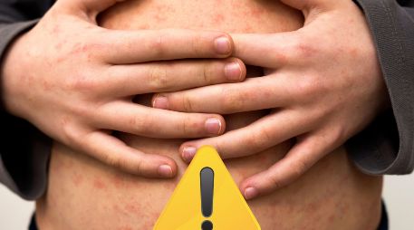 La Dirección General de Epidemiología apuntó que los casos graves son frecuentes en niños pequeños con malnutrición, y sobre todo en los que su sistema inmunitario está debilitado. ESPECIAL / CANVA