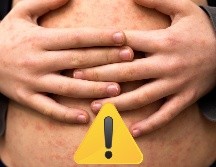 La Dirección General de Epidemiología apuntó que los casos graves son frecuentes en niños pequeños con malnutrición, y sobre todo en los que su sistema inmunitario está debilitado. ESPECIAL / CANVA