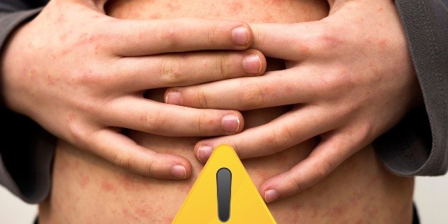 Sarampi&oacute;n: M&eacute;xico, primer lugar en Am&eacute;rica Latina en contagios de la enfermedad