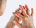 También llamada osteoartrosis es una condición que se agrava durante la temporada de frío y afecta de manera desproporcionada a las mujeres. ESPECIAL / CANVA