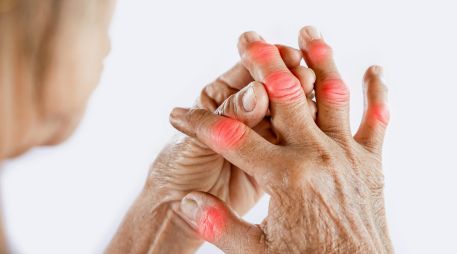 También llamada osteoartrosis es una condición que se agrava durante la temporada de frío y afecta de manera desproporcionada a las mujeres. ESPECIAL / CANVA