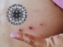 Hasta ahora, en Jalisco, solo una bebé de dos meses proveniente de Guerrero ha fallecido a causa de esta enfermedad. ESPECIAL / CANVA