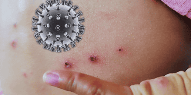 Sarampi&oacute;n en Jalisco: Por esta cifra, la Entidad ocupa el segundo lugar de contagios en M&eacute;xico