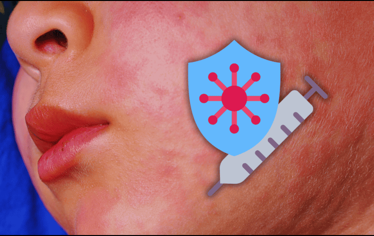 Ahora, Jalisco es el estado con mayor número de enfermos de sarampión en 2026, con 385 casos. ESPECIAL / CANVA