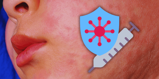 Sarampi&oacute;n en M&eacute;xico: Poco inter&eacute;s por la vacuna en este estado