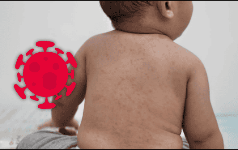 El sarampión es una enfermedad viral que puede iniciar con manifestaciones generales y evolucionar rápidamente. ESPECIAL / CANVA