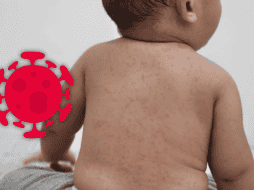 El sarampión es una enfermedad viral que puede iniciar con manifestaciones generales y evolucionar rápidamente. ESPECIAL / CANVA