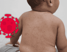 El sarampión es una enfermedad viral que puede iniciar con manifestaciones generales y evolucionar rápidamente. ESPECIAL / CANVA