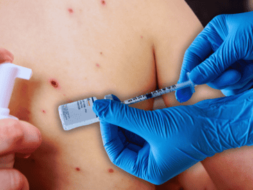 Jalisco ocupa el primer lugar nacional en lo que va del presente año en casos confirmados acumulados de sarampión, con 718. ESPECIAL / CANVA