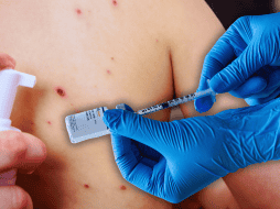 Jalisco ocupa el primer lugar nacional en lo que va del presente año en casos confirmados acumulados de sarampión, con 718. ESPECIAL / CANVA