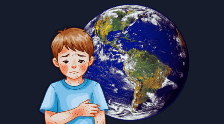 La disminución sostenida de las coberturas es el principal detonante del regreso del sarampión: ESPECIAL / CANVA