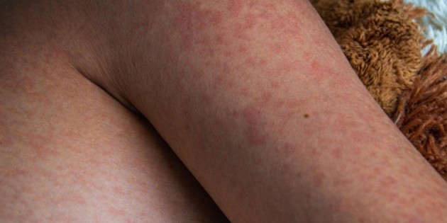 Sarampi&oacute;n en M&eacute;xico: Beb&eacute; muere por complicaciones asociadas a la enfermedad en Tlaxcala