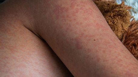 La Secretaría de Salud del estado de Tlaxcala informó el fallecimiento de un bebé de un año y un mes de edad a causa de complicaciones asociadas al sarampión. ESPECIAL / CANVA