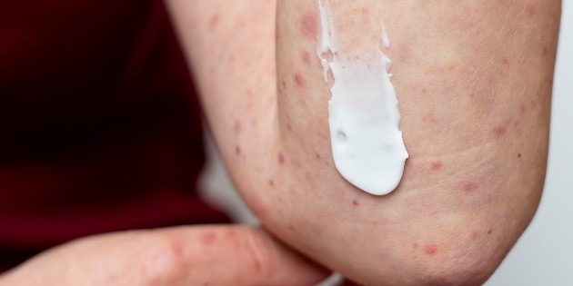 Sarampi&oacute;n: Jalisco roza los mil 500 casos acumulados