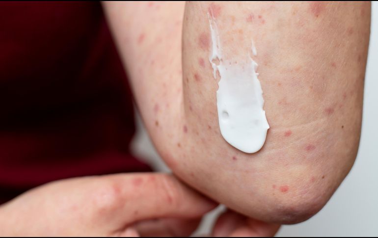 La mayoría de los casos se concentran en el Área Metropolitana de Guadalajara. FREEPIK