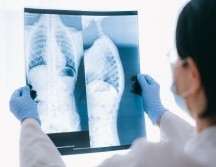 Se trata de Amivantab y Lazertinib, combinación de medicamentos ya disponible en México, que podría ser utilizado por la gran mayoría de pacientes con este tipo de cáncer como sustituto a la quimioterapia. Pexels