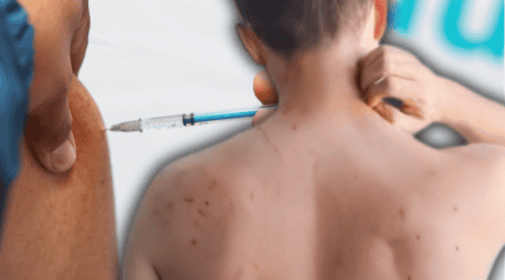 El sarampión es una enfermedad viral altamente contagiosa que no cuenta con un tratamiento específico para eliminar el virus, por lo que la atención médica se centra en aliviar los síntomas y evitar complicaciones. EL INFORMADOR / ESPECIAL