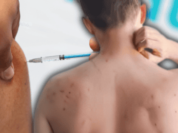 El sarampión es una enfermedad viral altamente contagiosa que no cuenta con un tratamiento específico para eliminar el virus, por lo que la atención médica se centra en aliviar los síntomas y evitar complicaciones. EL INFORMADOR / ESPECIAL