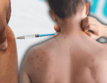 El sarampión es una enfermedad viral altamente contagiosa que no cuenta con un tratamiento específico para eliminar el virus, por lo que la atención médica se centra en aliviar los síntomas y evitar complicaciones. EL INFORMADOR / ESPECIAL