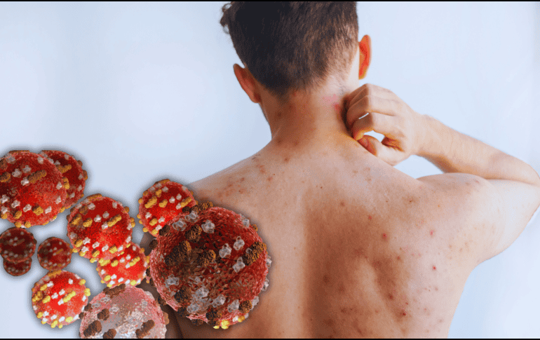 Los síntomas del sarampión pueden aparecer entre 10 y 14 días después del contagio. ESPECIAL / CANVA