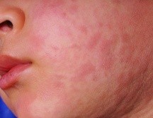 La Secretaría de Salud dio a conocer que en Hidalgo se registran siete casos confirmados de sarampión en los municipios de Pachuca, Actopan y Santiago de Anaya. Se trata de tres menores de edad y cuatro adultos. ESPECIAL / CANVA