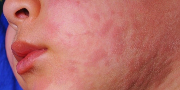 Sarampi&oacute;n: Implementan medidas por casos en tres municipios de Hidalgo