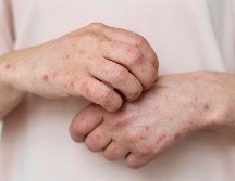 Si presentas fiebre y sarpullido o has estado en contacto con un caso sospechoso, acude de inmediato a tu centro de salud para recibir atención y evitar la propagación. FREEPIK