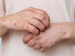 Si presentas fiebre y sarpullido o has estado en contacto con un caso sospechoso, acude de inmediato a tu centro de salud para recibir atención y evitar la propagación. FREEPIK