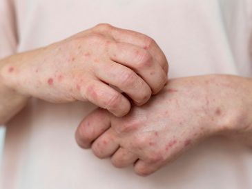 Si presentas fiebre y sarpullido o has estado en contacto con un caso sospechoso, acude de inmediato a tu centro de salud para recibir atención y evitar la propagación. FREEPIK