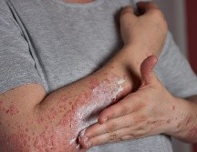 Con los cuidados adecuados, la mayoría de los casos se resuelven sin complicaciones graves. FREEPIk