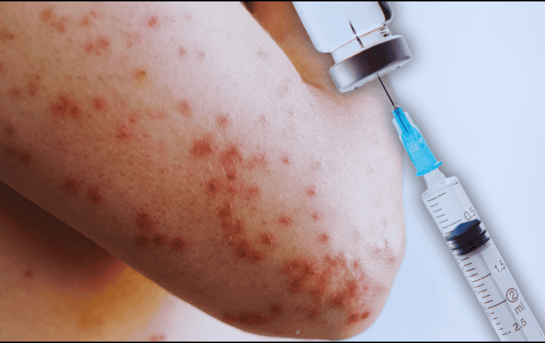 No hay tratamiento específico para el sarampión, y la mayoría de los pacientes se recuperan en 2 ó 3 semanas. ESPECIAL / CANVA