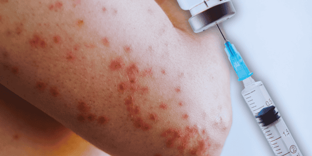 Sarampi&oacute;n en M&eacute;xico: &iquest;Adultos vacunados en la infancia deben hacerlo otra vez ante brote?