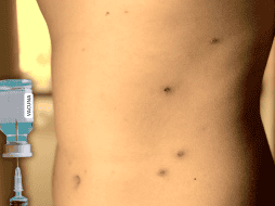 La recomendación general es que la población debe recibir un refuerzo adicional contra el sarampión, sin importar si se trata de menores de edad o personas adultas. ESPECIAL / CANVA