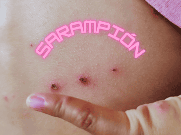 Un solo caso de sarampión puede generar entre 12 y 18 contagios en personas susceptibles. ESPECIAL / CANVA