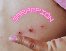 Un solo caso de sarampión puede generar entre 12 y 18 contagios en personas susceptibles. ESPECIAL / CANVA