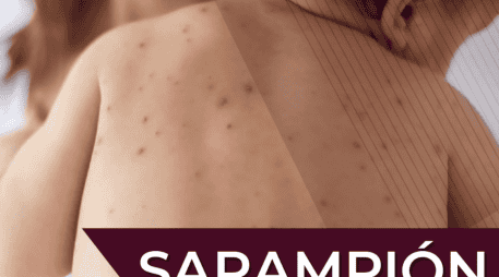 Las autoridades invitan a la población a acudir al  Centro de Salud o módulo de vacunación más cercano para recibir la vacuna contra el sarampión. Gobierno de México