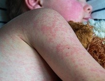 Jalisco confirmó 665 casos de sarampión en 2025, y mil 432 casos en lo que va de 2026, para dar un total de 2 mil 97 contagios. ESPECIAL/Canva