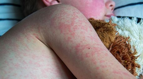 Jalisco confirmó 665 casos de sarampión en 2025, y mil 432 casos en lo que va de 2026, para dar un total de 2 mil 97 contagios. ESPECIAL/Canva