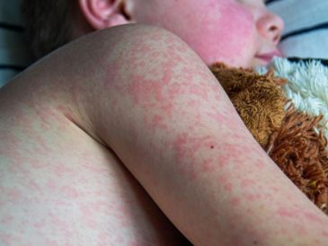 Jalisco confirmó 665 casos de sarampión en 2025, y mil 432 casos en lo que va de 2026, para dar un total de 2 mil 97 contagios. ESPECIAL/Canva