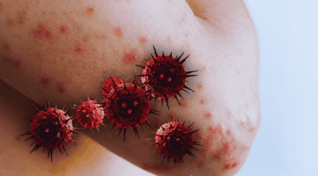 El riesgo del sarampión no se limita a la erupción cutánea, sino a las secuelas permanentes que puede dejar en el organismo. ESPECIAL / CANVA