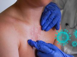 La manifestación clínica del sarampión ocurre días después del contagio inicial. PEXELS/ESPECIAL