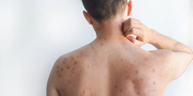 Sarampi&oacute;n: Lista de las alcald&iacute;as con m&aacute;s casos en CDMX