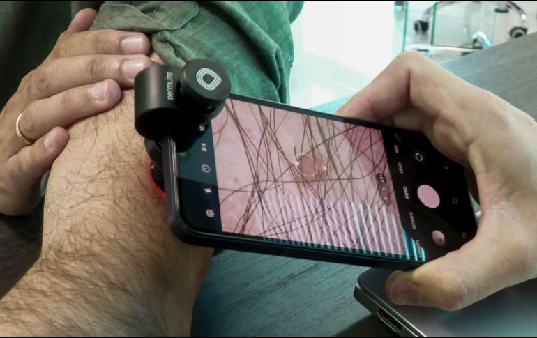 El telediagnóstico aplicado a la dermatología se erige como una opción eficaz y rápida para una detección temprana del melanoma, un cáncer de piel que se prevé que será diagnosticado con mayor fecuencia. EFE/D. Arjona